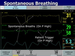 Spontaneous Breathing Spontaneous Breaths Patient Trigger (On P High) (On P High) 