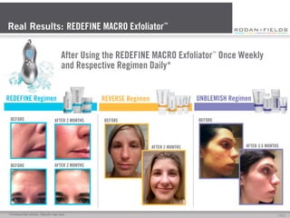 Real Results: REDEFINE MACRO Exfoliator™
After Using the REDEFINE MACRO Exfoliator Once Weekly
and Respective Regimen Daily*
™

REDEFINE Regimen
BEFORE

AFTER 2 MONTHS

UNBLEMISH Regimen

REVERSE Regimen

BEFORE

BEFORE

AFTER 2 MONTHS

BEFORE

AFTER 3.5 MONTHS

AFTER 2 MONTHS

*Unretouched photos. Results may vary.

[	
  11	
  ]	
  

 