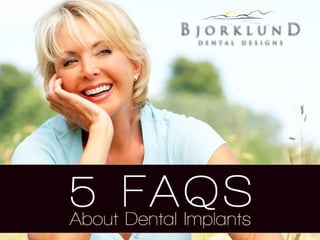 5 FAQS About Dental Implants