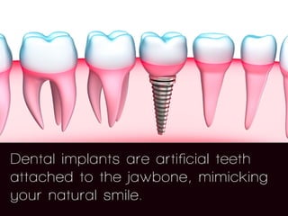 5 FAQS About Dental Implants