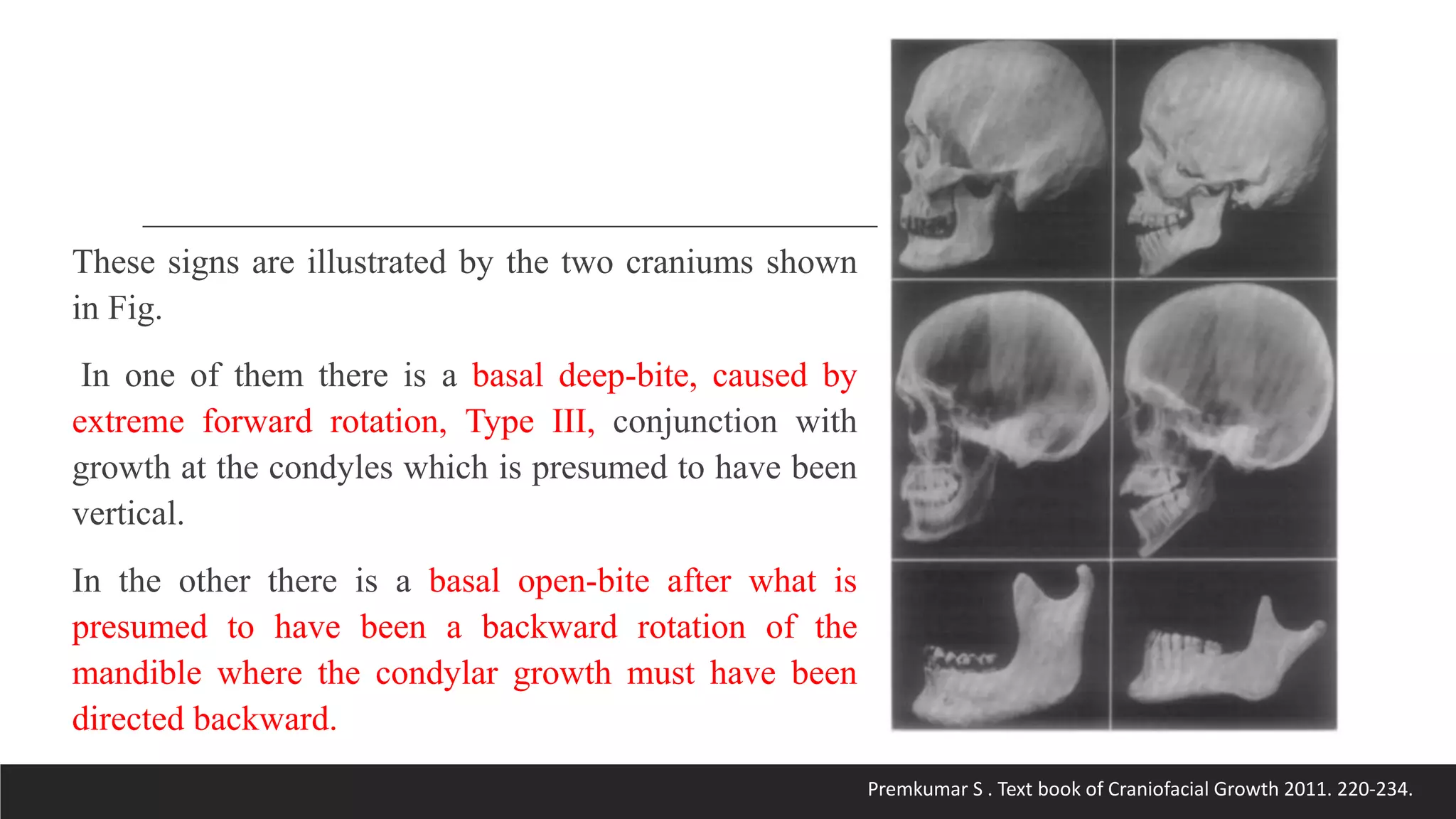 Bjork’s Concept of Jaw Rotation | PPTX