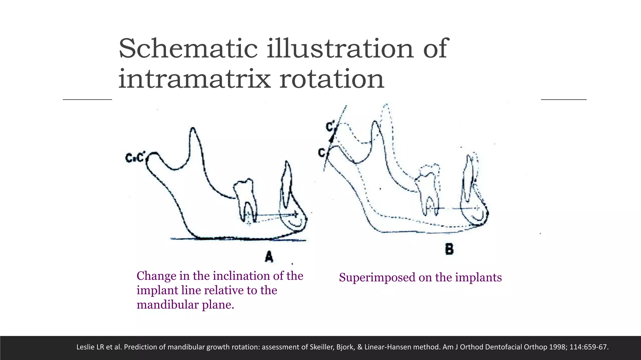 Bjork’s Concept of Jaw Rotation | PPTX