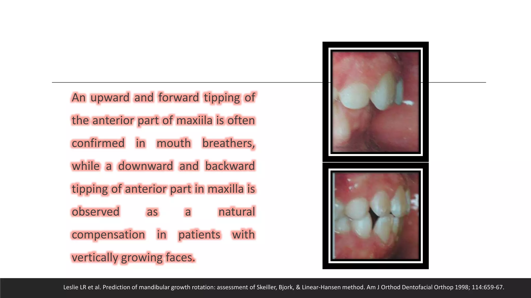 Bjork’s Concept of Jaw Rotation | PPTX