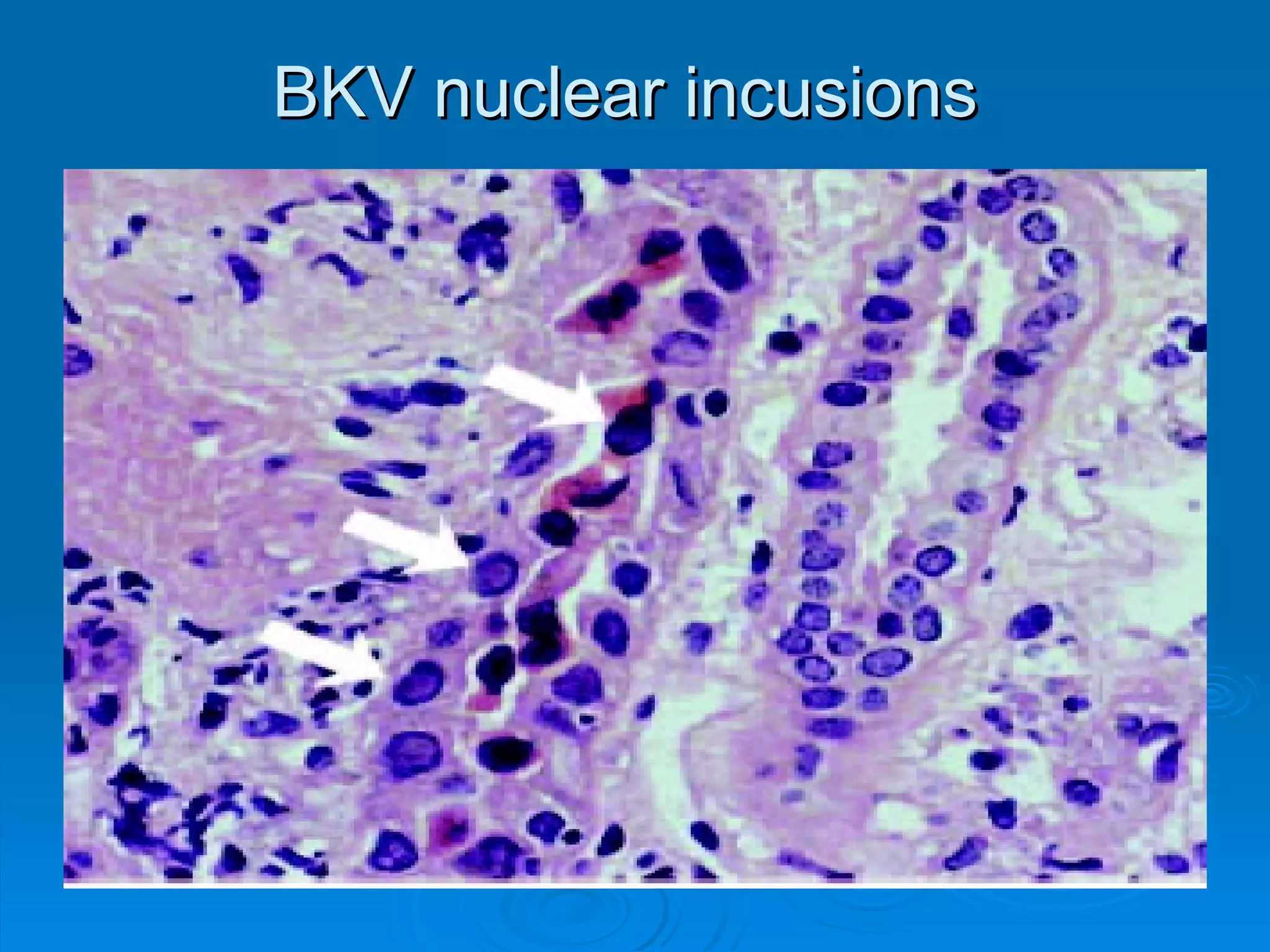BKV nuclear incusions  