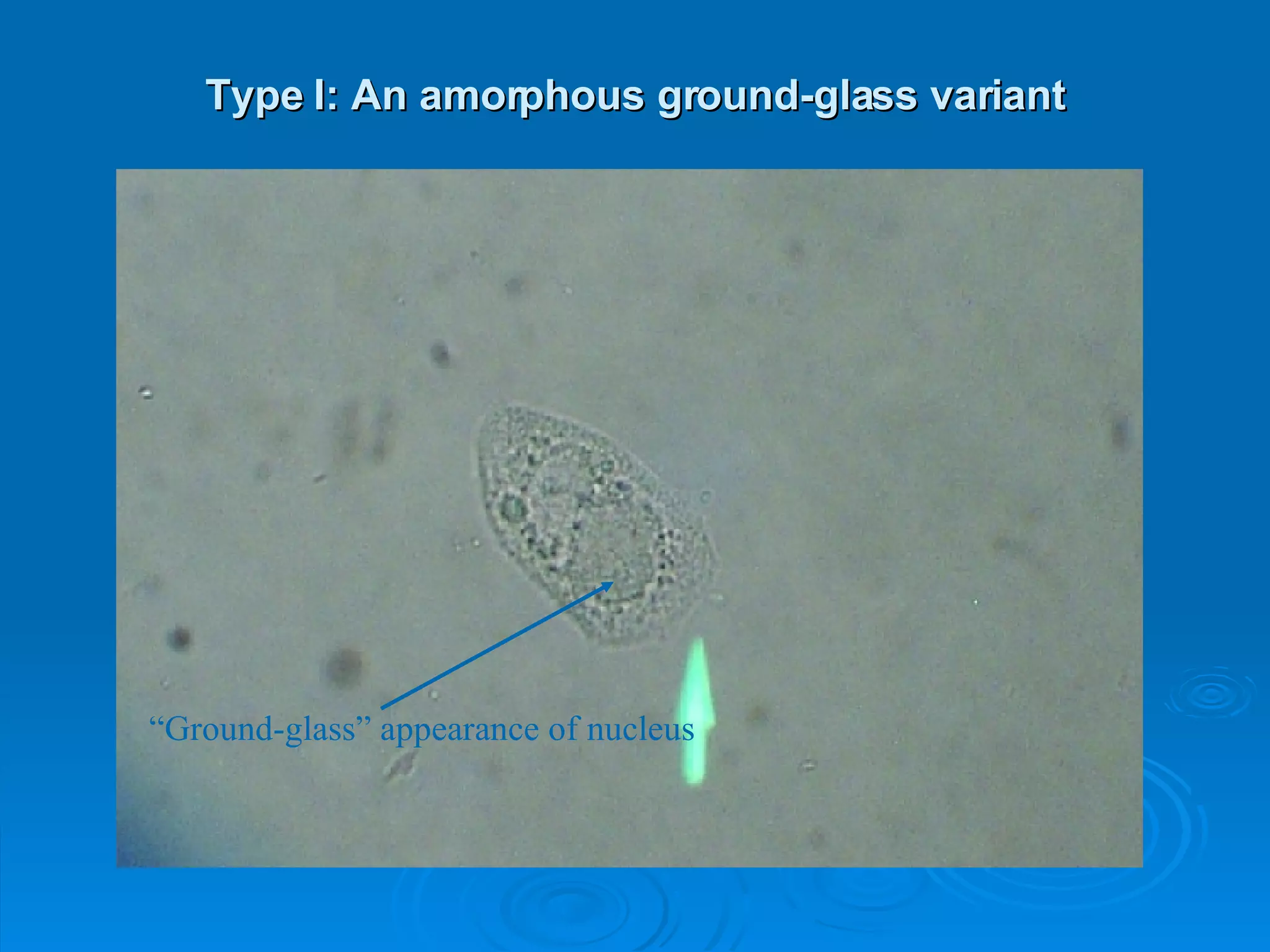 Type I: An amorphous ground-glass variant “ Ground-glass” appearance of nucleus 