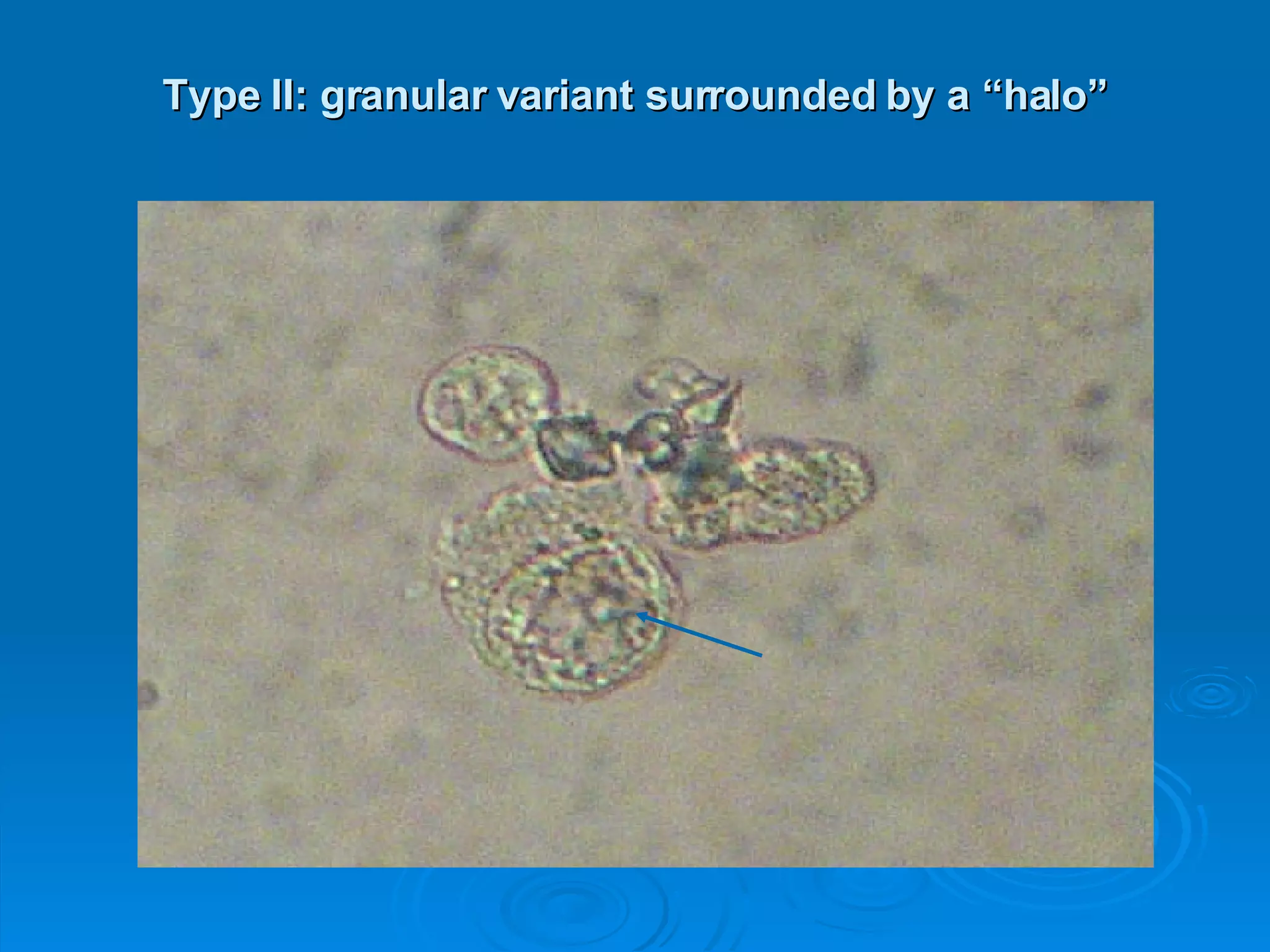 Type II: granular variant surrounded by a “halo” 