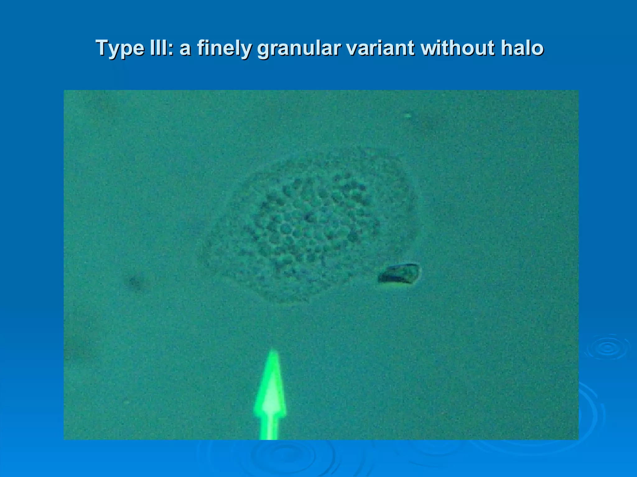 Type III: a finely granular variant without halo 