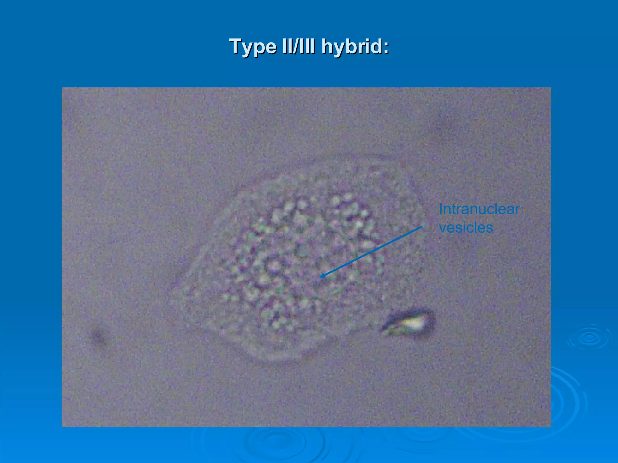 Type II/III hybrid: Intranuclear  vesicles 