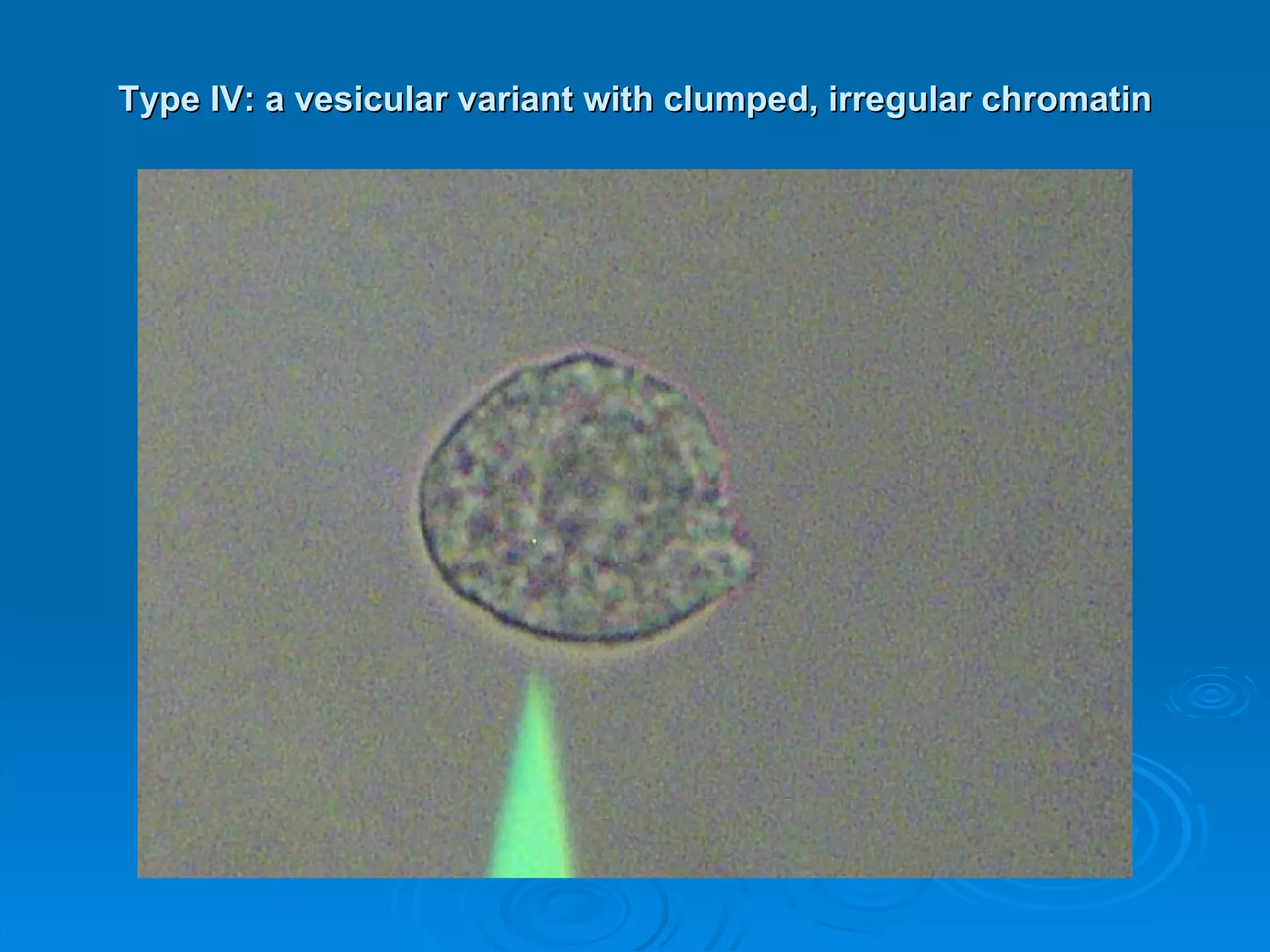 Type IV: a vesicular variant with clumped, irregular chromatin 