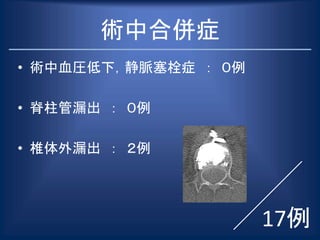 術中合併症
• 術中血圧低下，静脈塞栓症 ： ０例
• 脊柱管漏出 ： ０例
• 椎体外漏出 ： ２例
17例
 