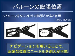 バルーンの膨張位置
・バルーンをクレフト外で膨張させると有用
岡本 , 骨折 2014
ナビゲーションを用いることで，
正確な位置にニードルを刺入が可能
 