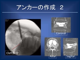 アンカーの作成 ２
Axial
Coronal
Sagital
Cleft部分
 