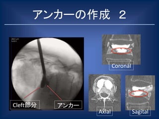 アンカーの作成 ２
Axial
Coronal
Sagital
Cleft部分 アンカー
 