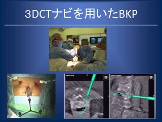 ３DCTナビを用いたBKP
 