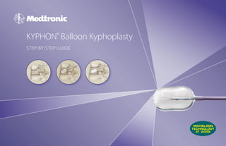 KYPHON® Balloon Kyphoplasty
STEP-BY-STEP GUIDE
 
