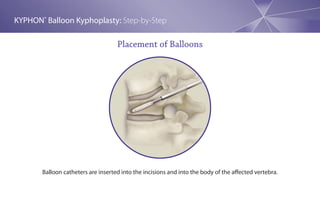 Kyphon Balloon Kyphoplasty Step By Step Procedure Guide | PDF