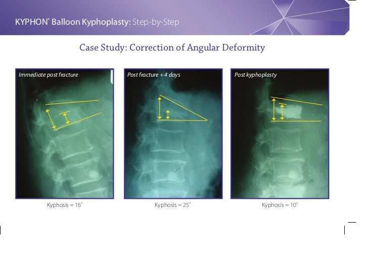 Balloon Kyphoplasty Step By Step Procedure Guide
