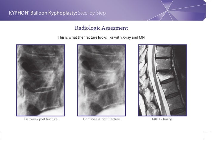 Balloon Kyphoplasty Step By Step Procedure Guide