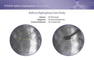 KYPHON® Balloon Kyphoplasty: Step-by-Step

                      Balloon Kyphoplasty Case Study
                                  Patient:   84 YO Female
                               Diagnosis:    Primary Osteoporosis
                        Fracture Reduced:    T8, 3 weeks old
 
