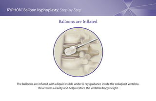 KYPHON® Balloon Kyphoplasty: Step-by-Step

                                      Balloons are Inflated




     The balloons are inflated with a liquid visible under X-ray guidance inside the collapsed vertebra.
                     This creates a cavity and helps restore the vertebra body height.
 