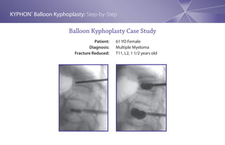 KYPHON® Balloon Kyphoplasty: Step-by-Step

                      Balloon Kyphoplasty Case Study
                                  Patient:   61 YO Female
                               Diagnosis:    Multiple Myeloma
                        Fracture Reduced:    T11, L2, 1 1/2 years old
 