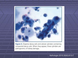 Nefrologia 2010;30(6):613-7
 