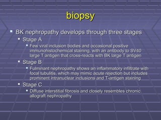 biopsybiopsy
 BK nephropathy develops through three stagesBK nephropathy develops through three stages
 Stage AStage A
 Few viral inclusion bodies and occasional positiveFew viral inclusion bodies and occasional positive
immunohistochemical staining, with an antibody to SV40immunohistochemical staining, with an antibody to SV40
large T antigen that cross-reacts with BK large T antigenlarge T antigen that cross-reacts with BK large T antigen
 Stage BStage B
 Fulminant nephropathy shows an inflammatory infiltrate withFulminant nephropathy shows an inflammatory infiltrate with
focal tubulitis, which may mimic acute rejection but includesfocal tubulitis, which may mimic acute rejection but includes
prominent intranuclear inclusions and T-antigen stainingprominent intranuclear inclusions and T-antigen staining
 Stage CStage C
 Diffuse interstitial fibrosis and closely resembles chronicDiffuse interstitial fibrosis and closely resembles chronic
allograft nephropathyallograft nephropathy
 