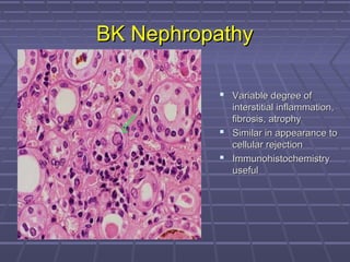 BK NephropathyBK Nephropathy
 Variable degree ofVariable degree of
interstitial inflammation,interstitial inflammation,
fibrosis, atrophyfibrosis, atrophy
 Similar in appearance toSimilar in appearance to
cellular rejectioncellular rejection
 ImmunohistochemistryImmunohistochemistry
usefuluseful
 