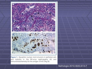 Nefrologia 2010;30(6):613-7
 