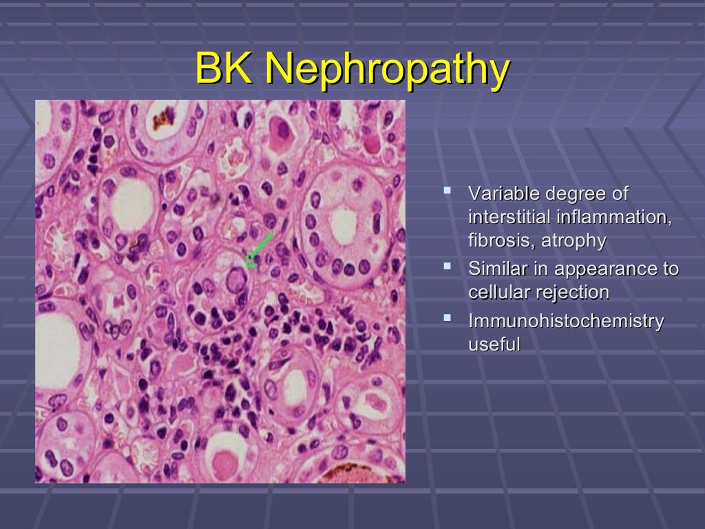 BK Virus Nephropathy