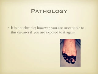 Pathology

• It is not chronic; however, you are susceptible to
  this diseases if you are exposed to it again.
 