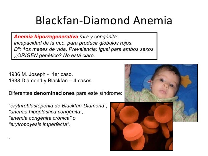Blackfan diamond