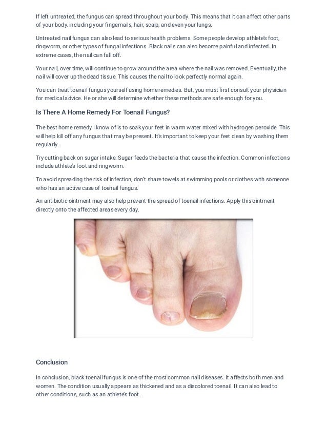 Black Toenail Fungus Causes, Symptoms And Their Treatment