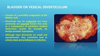 BLADDER OR VESICAL DIVERTICULUM
 Consists of a pouchlike evagination of the
bladder wall.
 Diverticula may be congenital but more
commonly are acquired lesions that arise
as a consequence of persistent urethral
obstruction caused, for example, by
benign prostatic hyperplasia.
 Although most diverticula are small and
asymptomatic, they sometimes lead to
urinary stasis and predispose to infection.
 