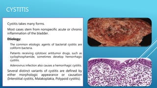 CYSTITIS
 Cystitis takes many forms.
 Most cases stem from nonspecific acute or chronic
inflammation of the bladder.
 Etiology:
1. The common etiologic agents of bacterial cystitis are
coliform bacteria.
2. Patients receiving cytotoxic antitumor drugs, such as
cyclophosphamide, sometimes develop hemorrhagic
cystitis.
3. Adenovirus infection also causes a hemorrhagic cystitis.
 Several distinct variants of cystitis are defined by
either morphologic appearance or causation
(Interstitial cystitis, Malakoplakia, Polypoid cystitis).
 