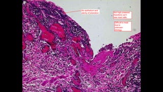 No epithelium and
plenty of ulceration. Not high powered,
therefore can't
see mast cells.
Difficult to treat
due to
unknown
etiology.
 