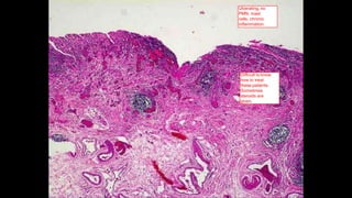 Ulcerating, no
PMN, mast
cells, chronic
inflammation.
Difficult to know
how to treat
these patients.
Sometimes
steroids are
given.
 