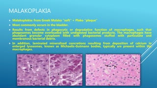 MALAKOPLAKIA
 Malakoplakia: from Greek Malako "soft" + Plako "plaque"
 Most commonly occurs in the bladder.
 Results from defects in phagocytic or degradative function of macrophages, such that
phagosomes become overloaded with undigested bacterial products. The macrophages have
abundant granular cytoplasm filled with phagosomes stuffed with particulate and
membranous bacterial debris.
 In addition, laminated mineralized concretions resulting from deposition of calcium in
enlarged lysosomes, known as Michaelis-Gutmann bodies, typically are present within the
macrophages.
 