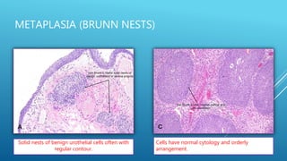 METAPLASIA (BRUNN NESTS)
Solid nests of benign urothelial cells often with
regular contour.
Cells have normal cytology and orderly
arrangement.
 