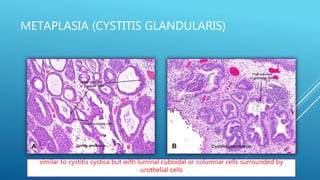 METAPLASIA (CYSTITIS GLANDULARIS)
similar to cystitis cystica but with luminal cuboidal or columnar cells surrounded by
urothelial cells
 