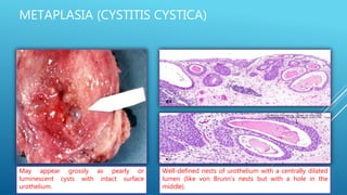 METAPLASIA (CYSTITIS CYSTICA)
May appear grossly as pearly or
luminescent cysts with intact surface
urothelium.
Well-defined nests of urothelium with a centrally dilated
lumen (like von Brunn's nests but with a hole in the
middle).
 