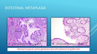 INTESTINAL METAPLASIA
identical to typical cystitis glandularis but with presence of goblet cells
 