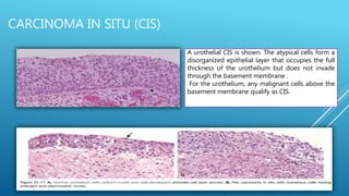 A urothelial CIS is shown. The atypical cells form a
disorganized epithelial layer that occupies the full
thickness of the urothelium but does not invade
through the basement membrane .
For the urothelium, any malignant cells above the
basement membrane qualify as CIS.
CARCINOMA IN SITU (CIS)
 