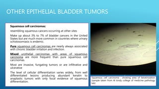 OTHER EPITHELIAL BLADDER TUMORS
 Squamous cell carcinomas:
 resembling squamous cancers occurring at other sites
 Make up about 3% to 7% of bladder cancers in the United
States but are much more common in countries where urinary
schistosomiasis is endemic.
 Pure squamous cell carcinomas are nearly always associated
with chronic bladder irritation and infection.
 Mixed urothelial carcinomas with areas of squamous
carcinoma are more frequent than pure squamous cell
carcinomas.
 Most are invasive, fungating tumors or are infiltrative and
ulcerative
 The level of cellular differentiation varies widely, from well
differentiated lesions producing abundant keratin to
anaplastic tumors with only focal evidence of squamous
differentiation.
Squamous cell carcinoma : showing area of keratinization
(sample taken from Al kindy college of medicine pathology
lab)
 