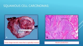SQUAMOUS CELL CARCINOMAS:
Gross: large necrotic mass that is typically invasive Keratin production
 
