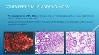 OTHER EPITHELIAL BLADDER TUMORS
 Adenocarcinomas of the bladder are rare and are histologically identical to adenocarcinomas
seen in the gastrointestinal tract.
 Some arise from urachal remnants in the dome of the bladder or in association with extensive
intestinal metaplasia.
 