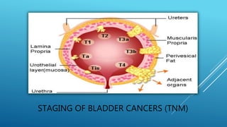 STAGING OF BLADDER CANCERS (TNM)
 
