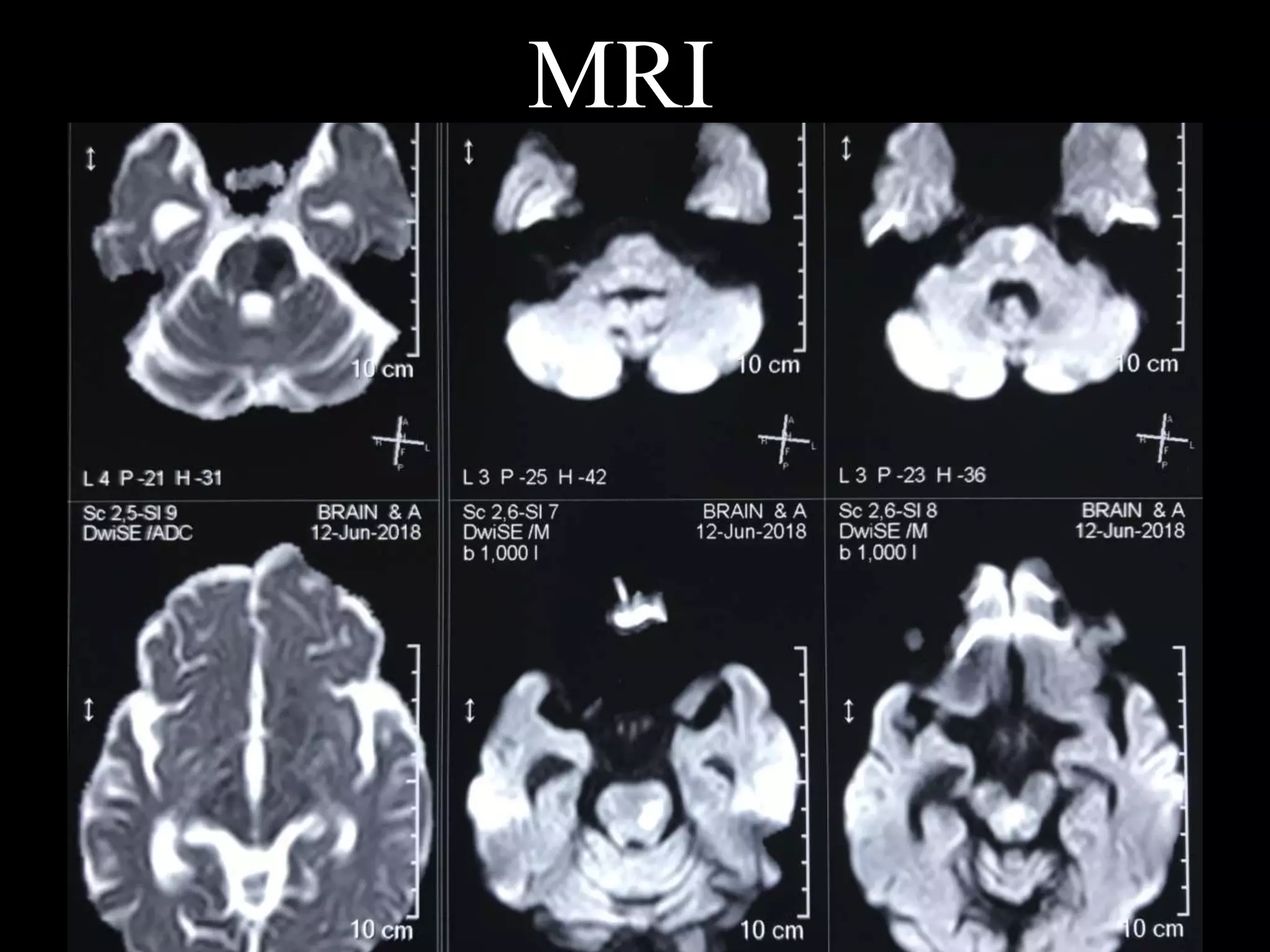 MRI
 