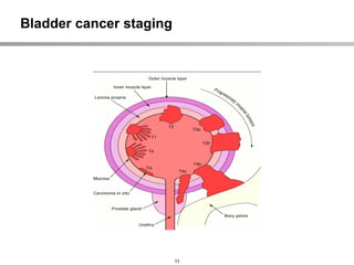 nccn bladder cancer guidelines for the treatment of bladder cancer | PPTX