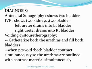 Voiding cystouretherography:
-- Catheterize both the urethras and fill both
bladders
--when pts void :both bladder contract
simultaneously so the urethras are outlined
with contrast material simultaneously
DIAGNOSIS:
Antenatal Sonography : shows two bladder
IVP : shows two kidneys ,two bladder
left ureter drains into Lt bladder
right ureter drains into Rt bladder
20
Dept of Urology, GRH and KMC, Chennai.
 